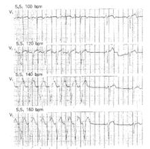 房室結內折返性心動過速