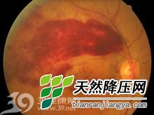 高血壓視網膜病變 高血壓視網膜病變