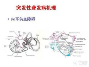 突發性聾 突發性聾