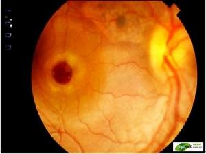 《黃斑裂孔的手術治療》