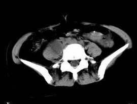 寒性膿腫 寒性膿腫