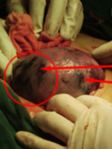 子宮胎盤卒中 子宮胎盤卒中