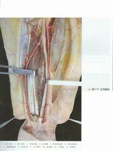 旋前方肌肌皮瓣手術示圖