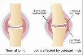 結核風濕症 結核風濕症