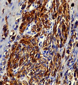 原發性食管惡性黑色素瘤