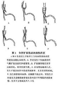 器械性食管損傷