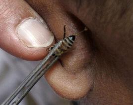 蜂蜇療法 蜂蜇療法