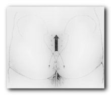 隱性脊柱裂 隱性脊柱裂