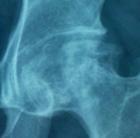 股骨頭囊變 股骨頭囊變