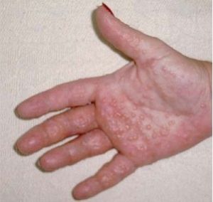 出汗障礙性濕疹 出汗障礙性濕疹