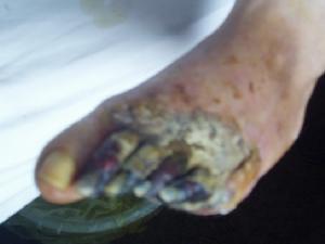 急性動脈栓塞 急性動脈栓塞