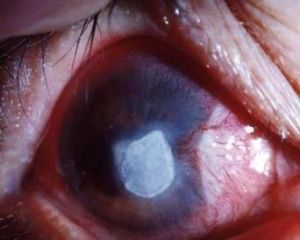 角膜挫傷 角膜挫傷