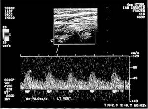 椎動脈造影 椎動脈造影
