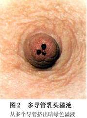 乳頭溢液