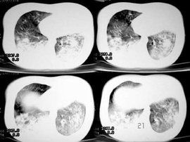 酵母菌感染 酵母菌感染