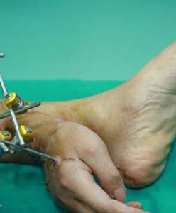 腳踝斷手 腳踝斷手