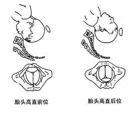 胎頭高直位 胎頭高直位