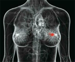 三陰乳腺癌 三陰乳腺癌