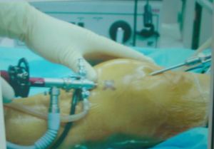 膝關節半月板損傷