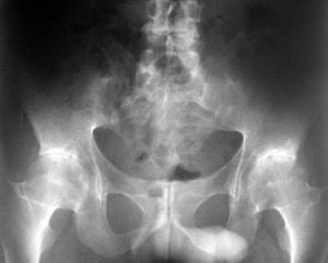 退行性脊柱炎 退行性脊柱炎