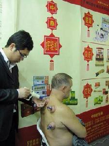 中國真空拔罐器 中國真空拔罐器