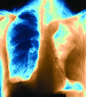 急性化膿性胸膜炎 急性化膿性胸膜炎