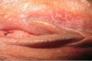 陰道口尖銳濕疣 陰道口尖銳濕疣