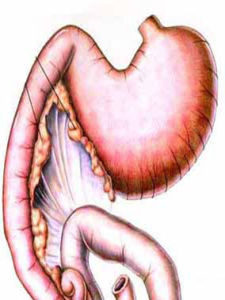 胃腸神經官能症 胃腸神經官能症