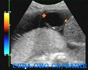 臍帶囊腫 臍帶囊腫