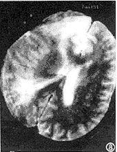 兒童急性病毒性腦炎