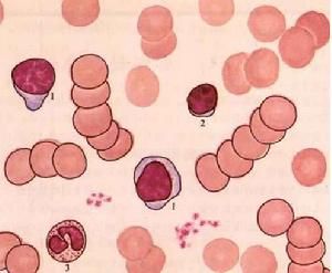 肝腎綜合徵 肝腎綜合徵
