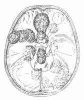 顱內腫瘤 顱內腫瘤