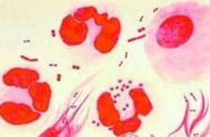 淋病潛伏期 淋病潛伏期