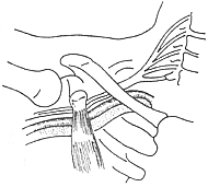 胸廓出口綜合症