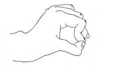 Froment征 Froment征