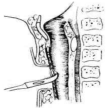氣切手術側面圖