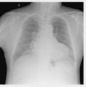 多器官功能衰竭 多器官功能衰竭