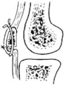 髕骨骨折切開復位內固定術 髕骨骨折切開復位內固定術