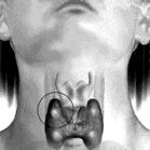 原發性甲狀旁腺功能亢進 原發性甲狀旁腺功能亢進