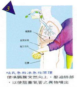 哈姆立克手法 哈姆立克手法