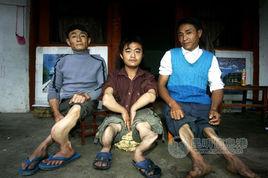 瓷娃娃病 瓷娃娃病