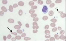 維生素B12缺乏導致惡性貧血