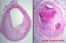 冠狀動脈粥樣硬化