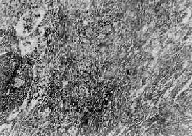 真菌過敏性哮喘