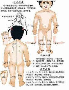 小兒熱性痙攣 小兒熱性痙攣