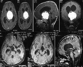惡性垂體瘤 惡性垂體瘤