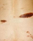 血小板低 血小板低