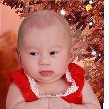 小頭畸形 小頭畸形