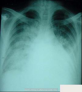 慢性心功能不全