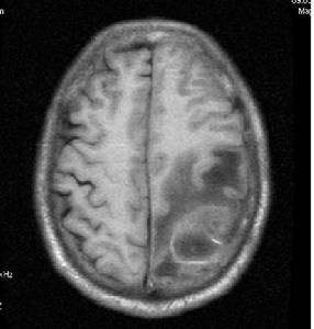（圖）腦膿腫